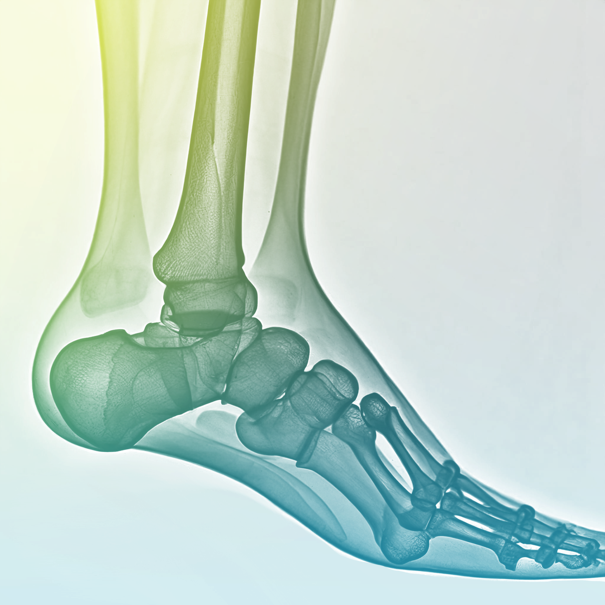 Ankle Osteoarthritis