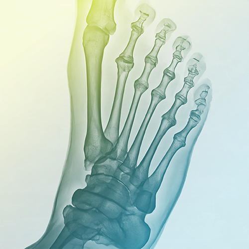 Foot Surgery